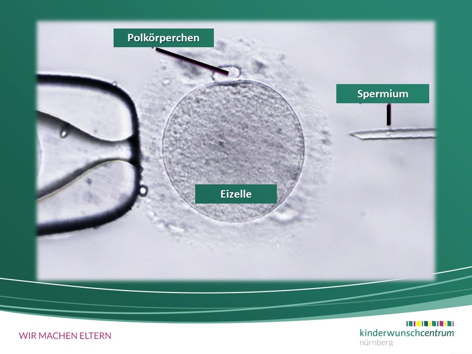 Intracytoplasmatische Spermatozoeninjektion (ICSI)