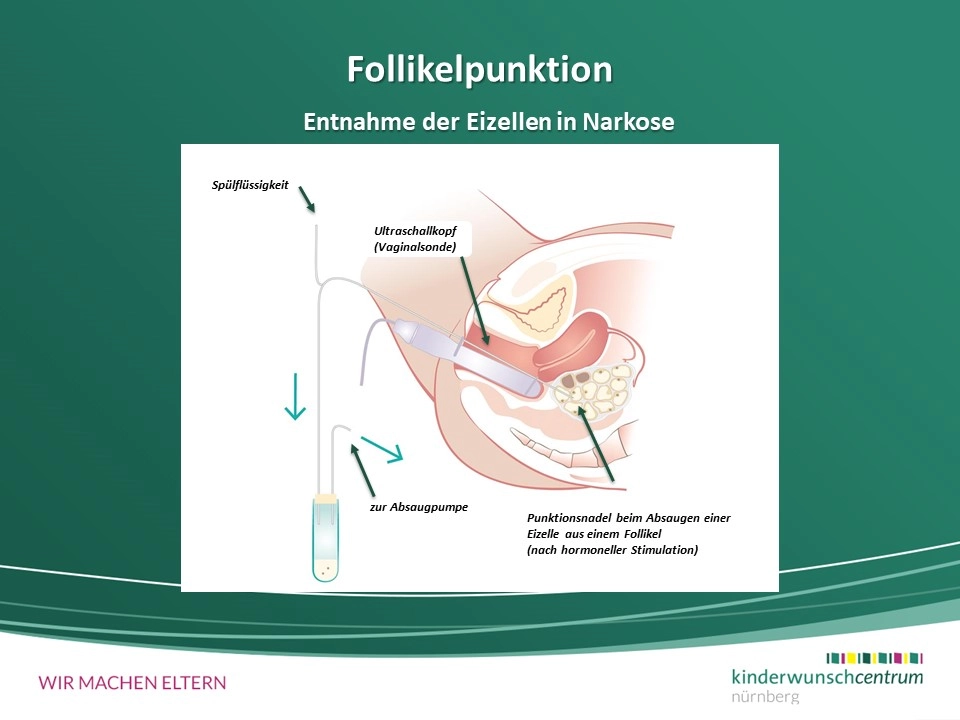 In-vitro-Fertilisation (IVF)