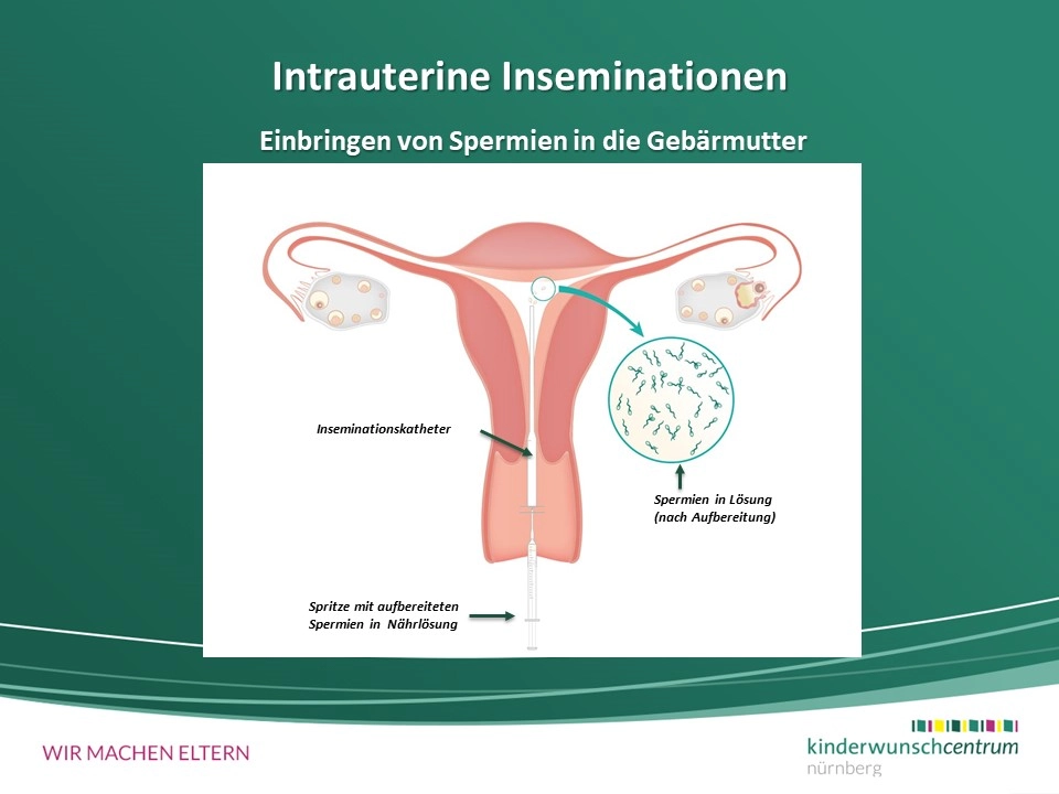 Heterologe Insemination