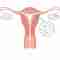 Intrauterine Insemination